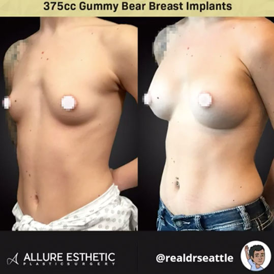 Before and After 375cc Gummy Bear Implants by Real Dr. Seattle