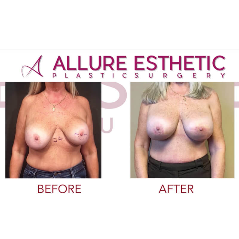 Botched Plastic Surgery Breast Augmentation Repair