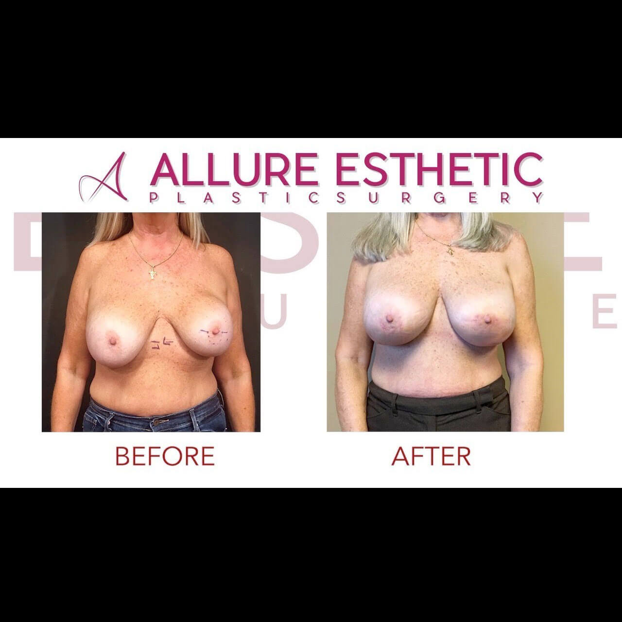 Botched Plastic Surgery Breast Augmentation Repair