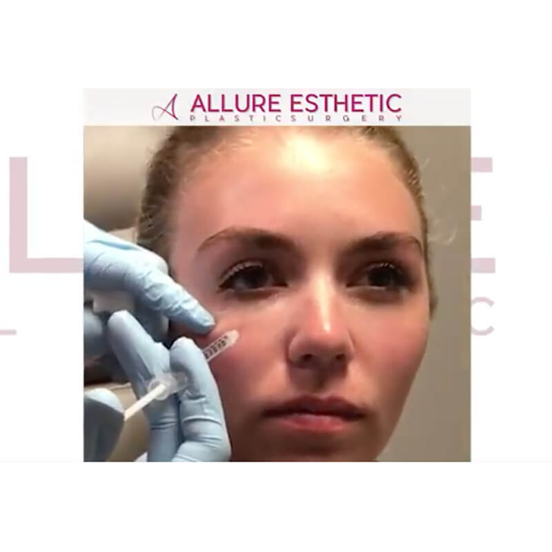 Dissolving Fillers in Seattle