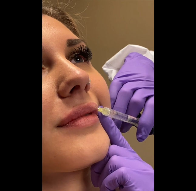 If you are nervous for your first lip filler appointment, we got you!
