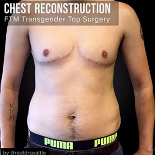 Best Seattle FTM Top Surgery