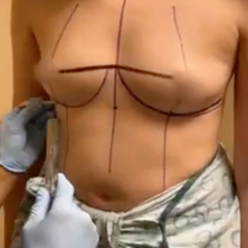 Breast Augmentation Surgery with the most DRAMATIC Results! 515cc Gummy Bear Implants | 2021 Surgery