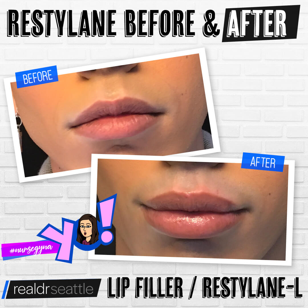 Restylane Seattle