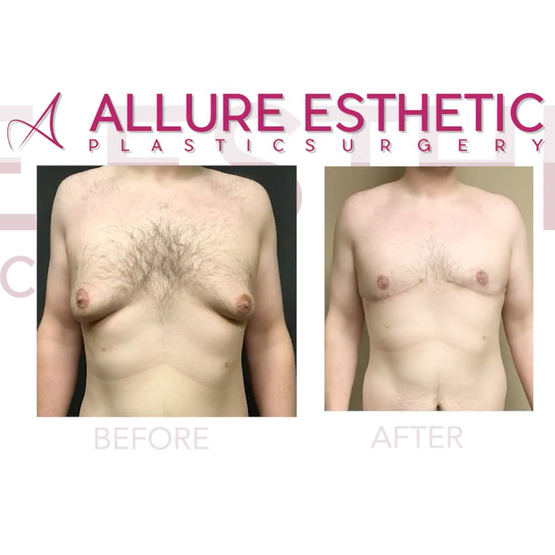 Gynecomastia Male Breast Removal Surgery