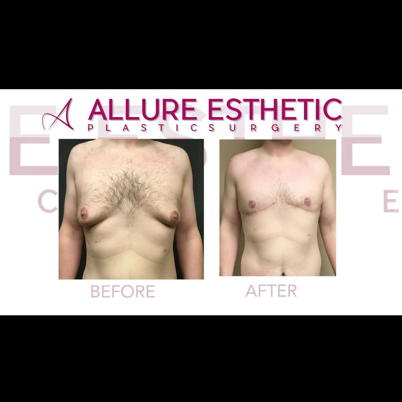 Gynecomastia Male Breast Removal Surgery