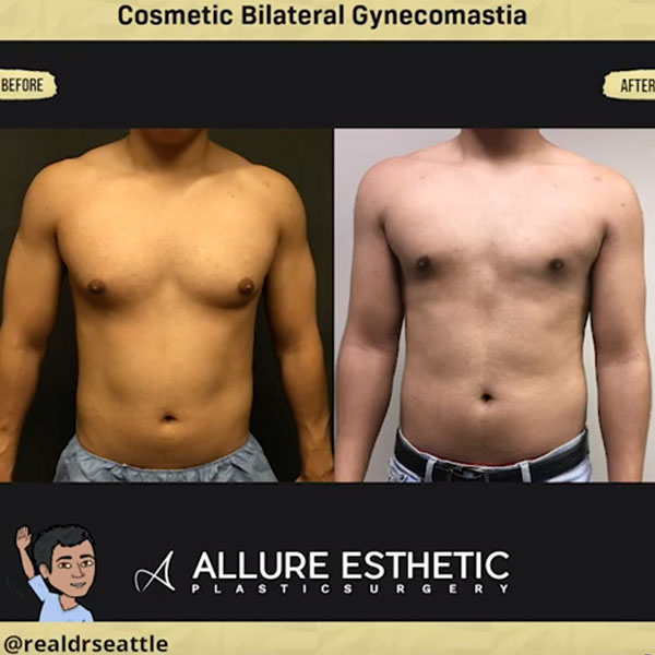 How is Gynecomastia aka Male Breast Reduction Surgery Performed?