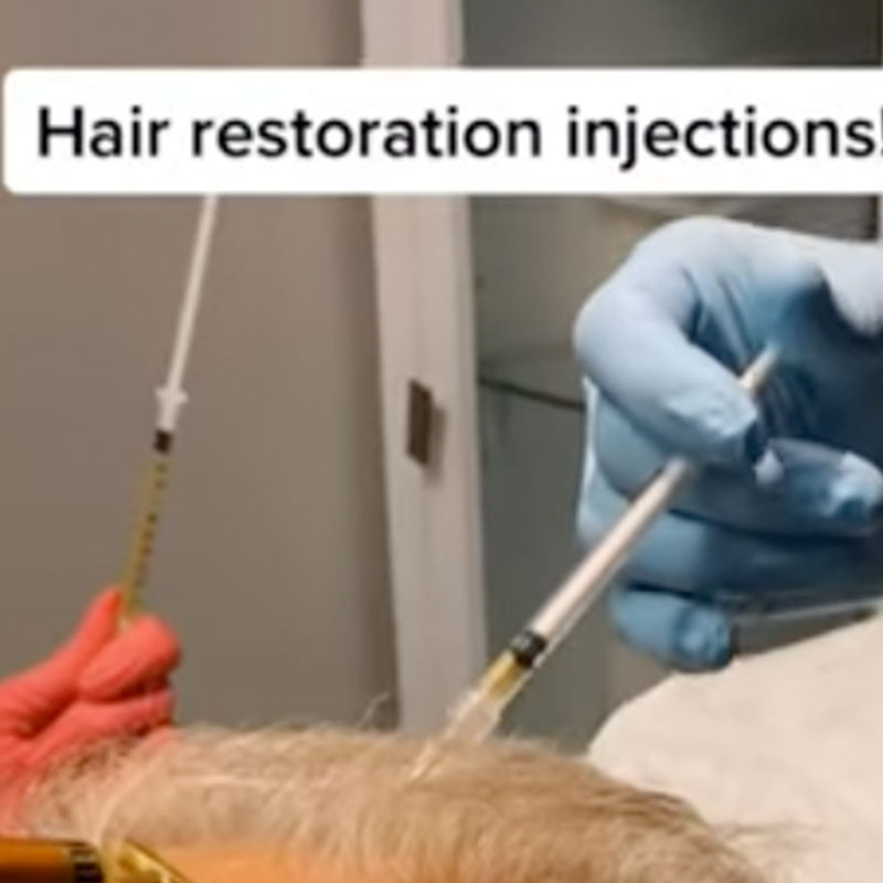 Hair Loss Treatment Injections by Plastic Surgeon, Dr. Seattle!