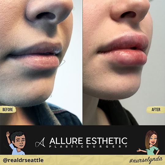 Lip Augmentation Seattle