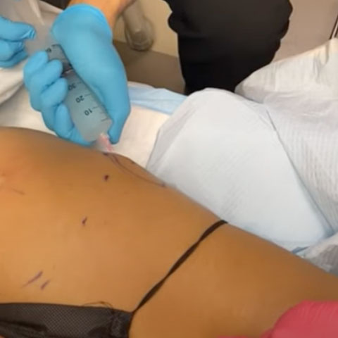 Non Surgical BBL- Brazilian Butt Lift! Non-Invasive & Long Lasting by #1 Plastic Surgeon in Seattle