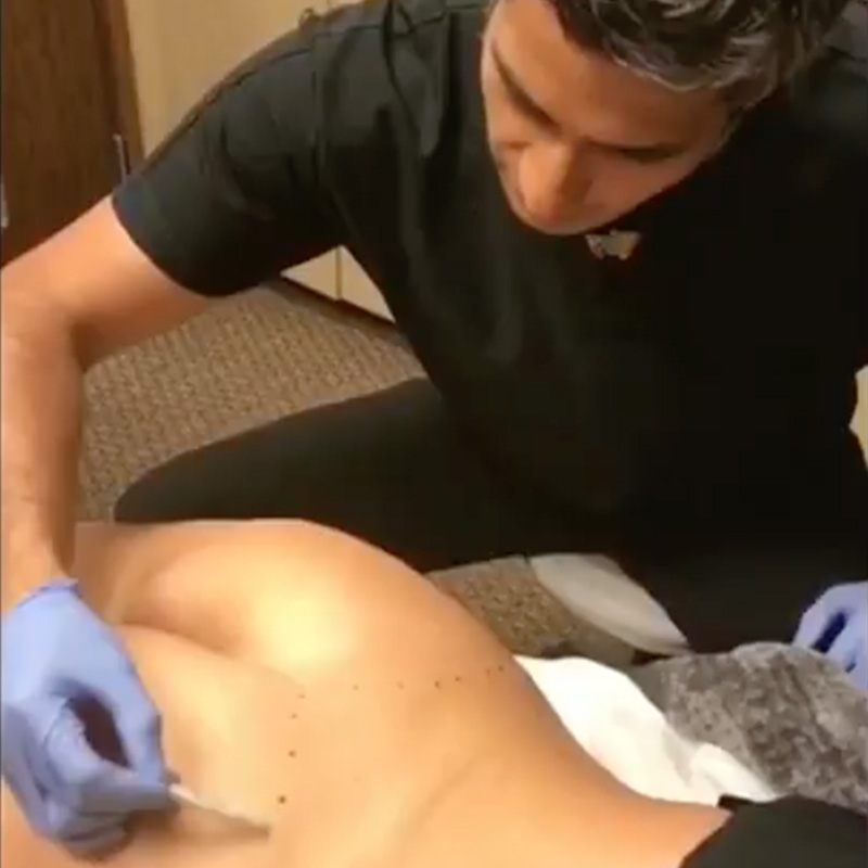 Non Surgical Brazilian Butt Lift: Biggest One Ever Created Non surgically