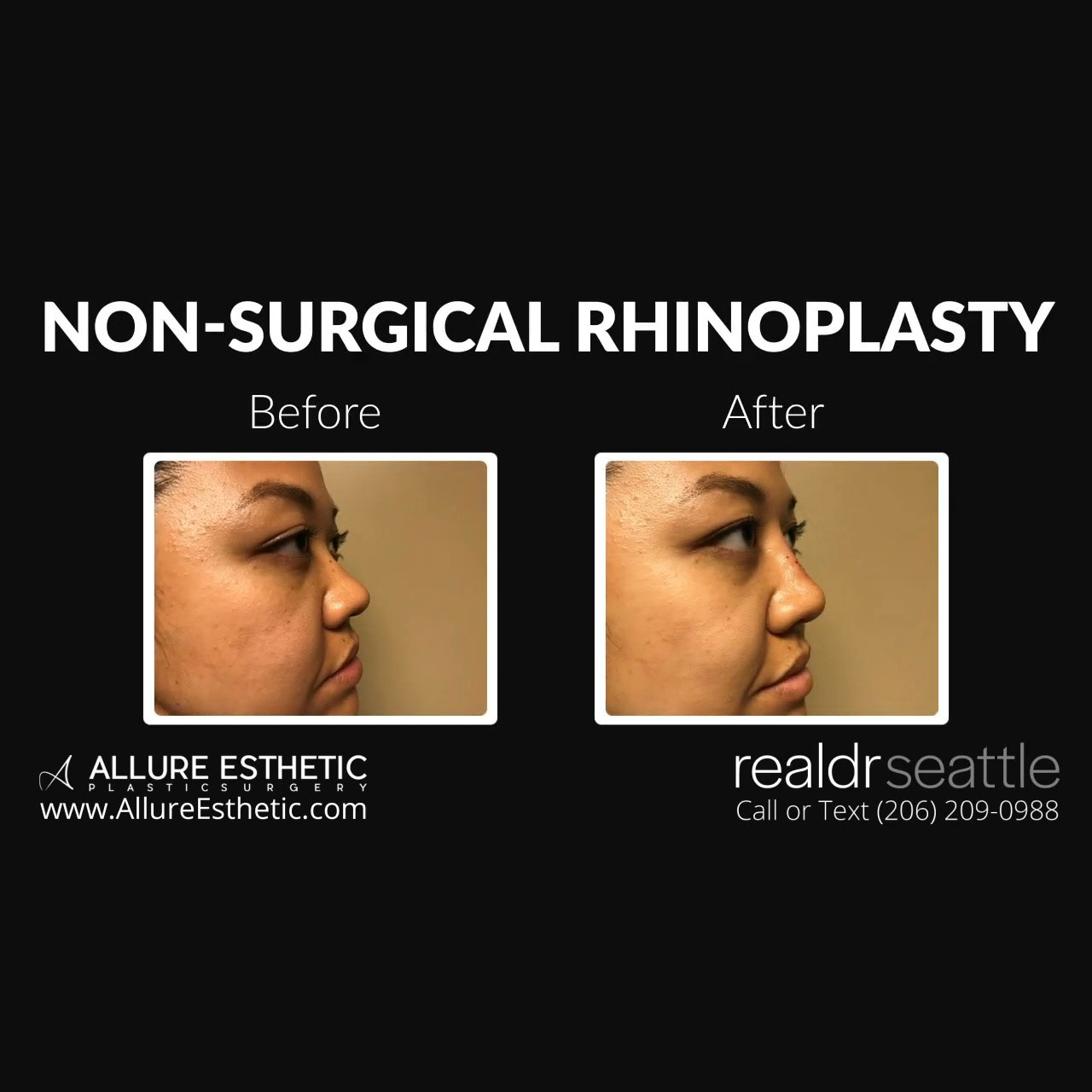 Non-Surgical Rhinoplasty! Best Technique to Build a Bridge for Asian Noses by Dr. Seattle