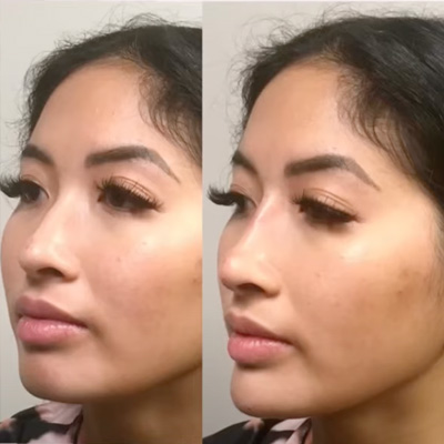 NON SURGICAL NOSE JOB! NO surgery NO downtime! Before and After