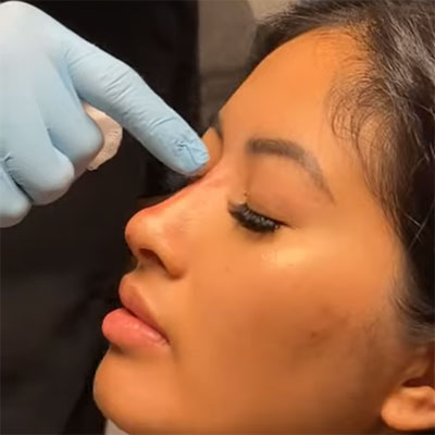Non-Surgical Rhinoplasty + Chin Filler for Defined Jawline and Perkier Nose Tip!