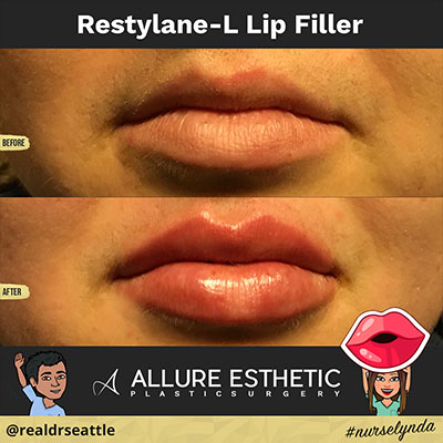 Restylane Seattle