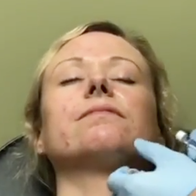 Restylane Seattle