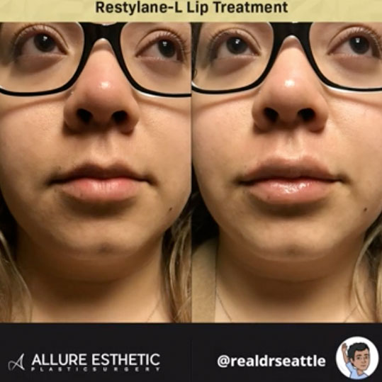 Seattle Lip Filler Injections by the Real Doctor Seattle