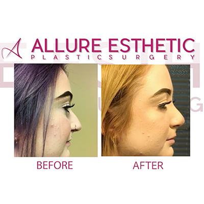 Revision rhinoplasty - Rhinoplasty in Seattle - Rhinoplasty Surgeon