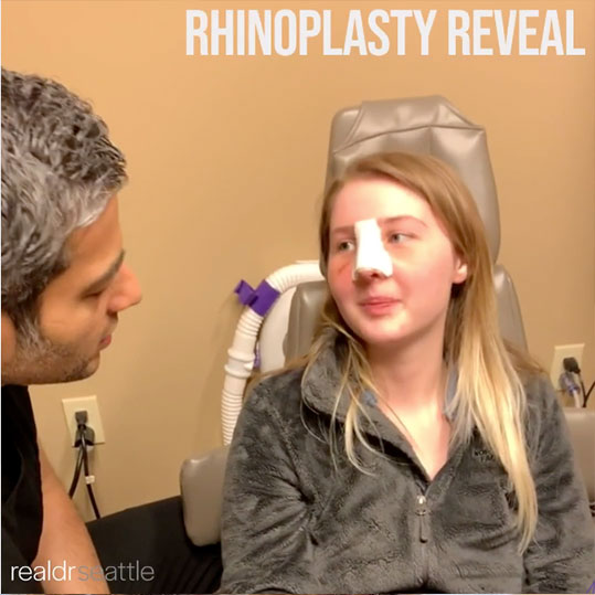Rhinoplasty In Seattle