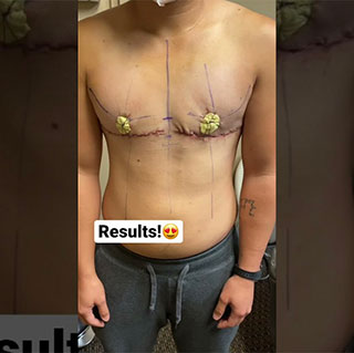 Best Seattle FTM Top Surgery