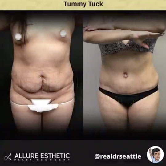 Seattle Tummy Tuck Surgery with Liposuction | Seattle's Top Plastic Surgeon