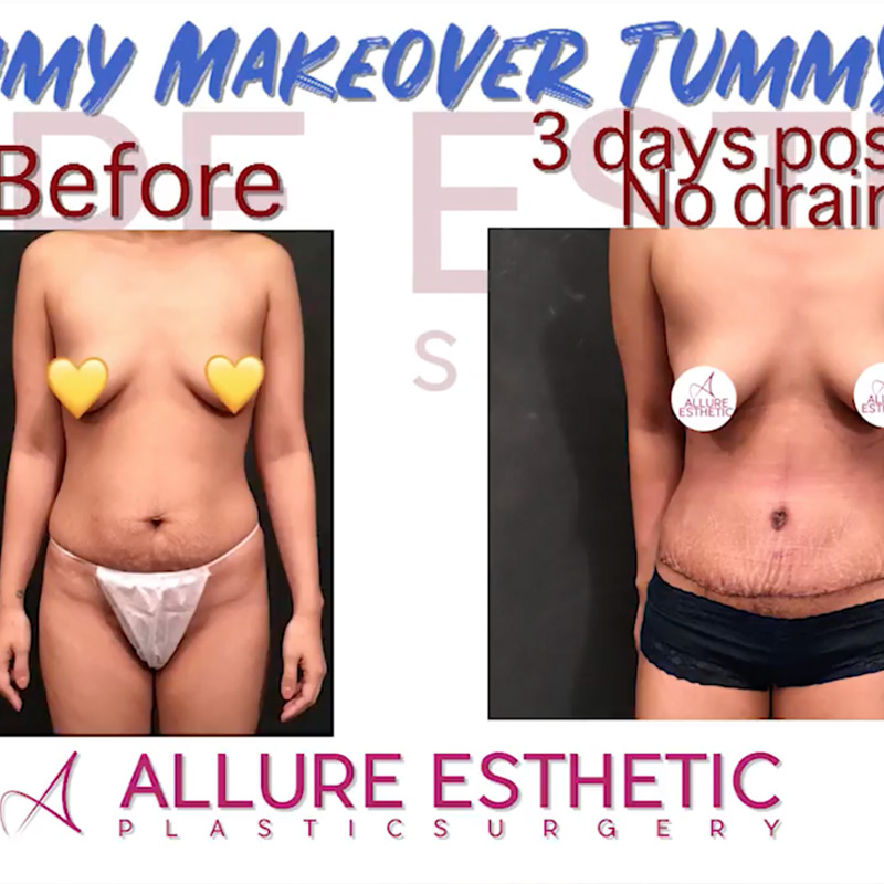 Best Mommy Makeover in Seattle