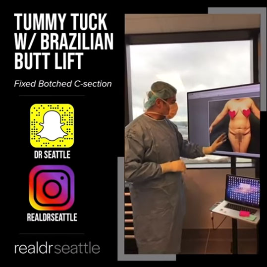 Tummy Tuck & Brazilian Butt Lift by Top Seattle Plastic Surgeon
