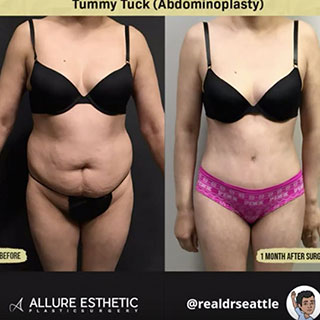 Tummy Tuck Seattle