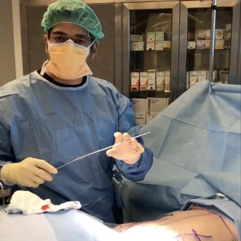 Vaser HD Liposuction