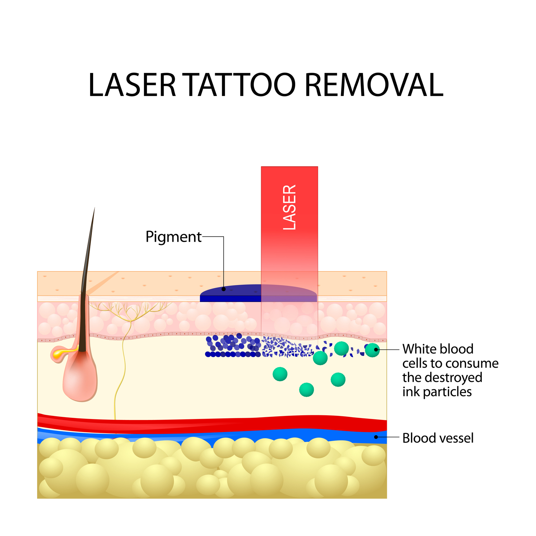 best tattoo removal method