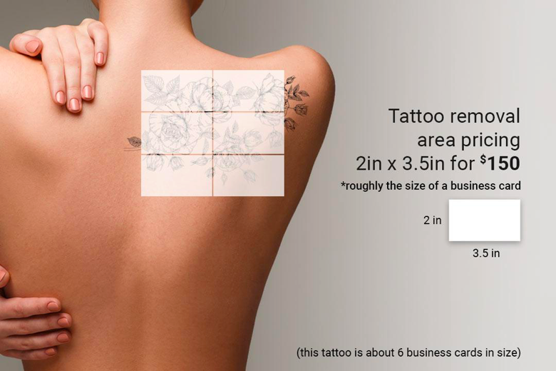 Tattoo Removal Pricing Seattle