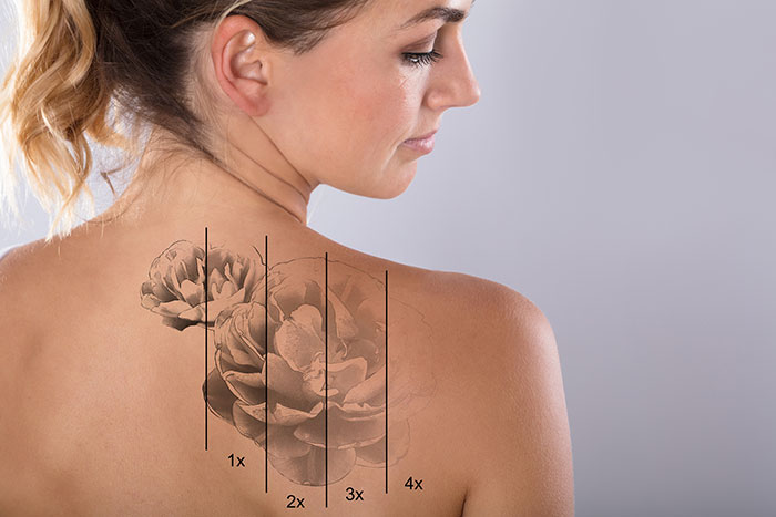 Tattoo Removal in Seattle