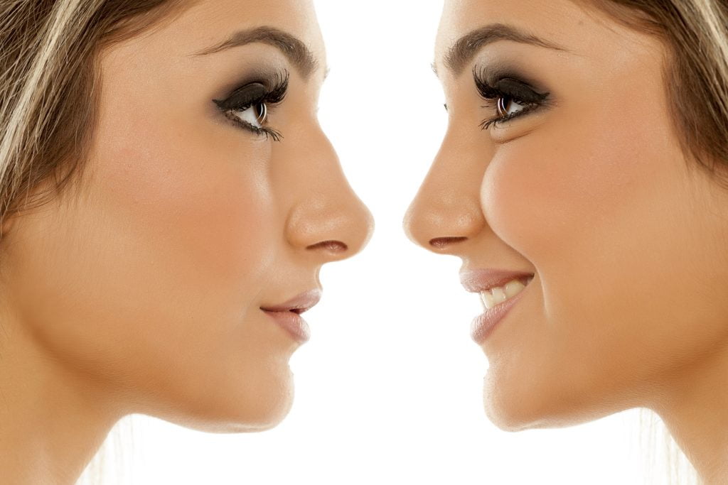 Rhinoplasty Results