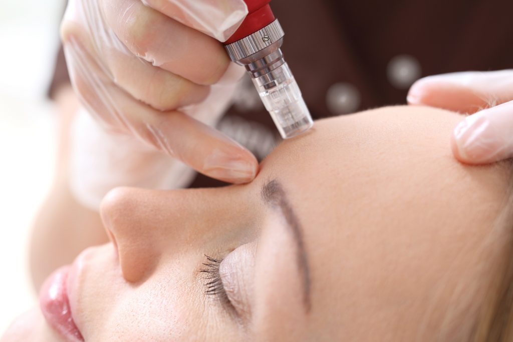 Microneedling Scar Removal Treatment In Seattle