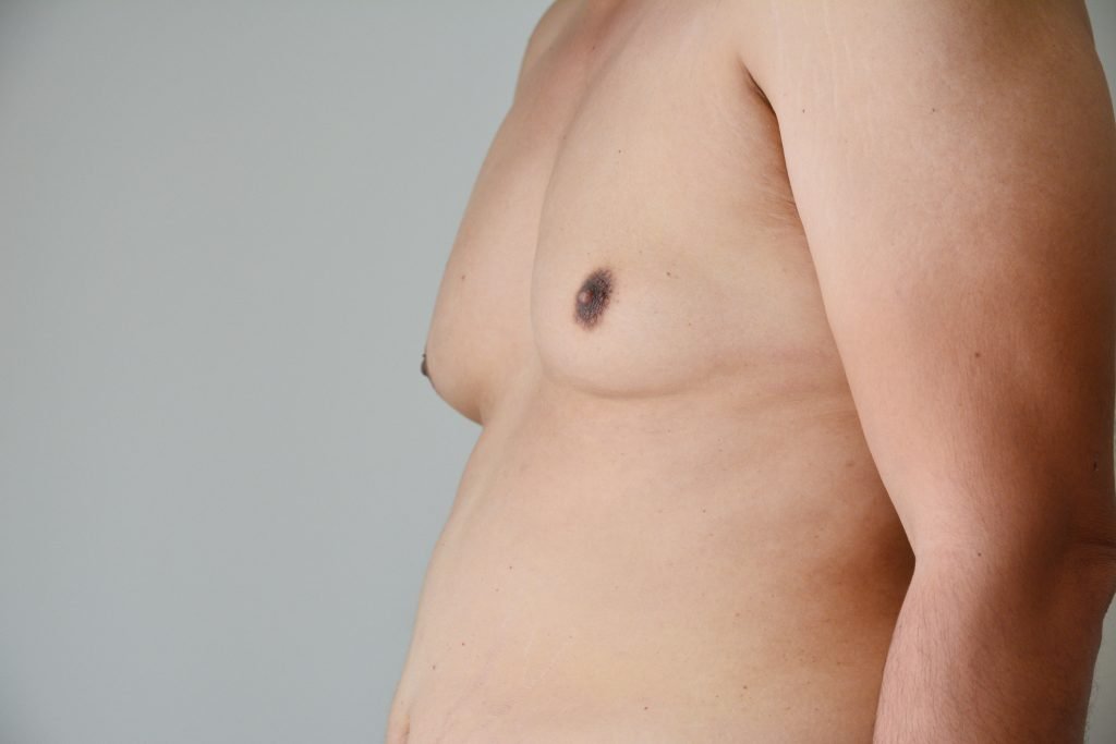 Gynecomastia Causes