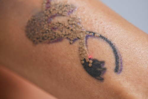 Does Laser Tattoo Removal Scar? | Removery
