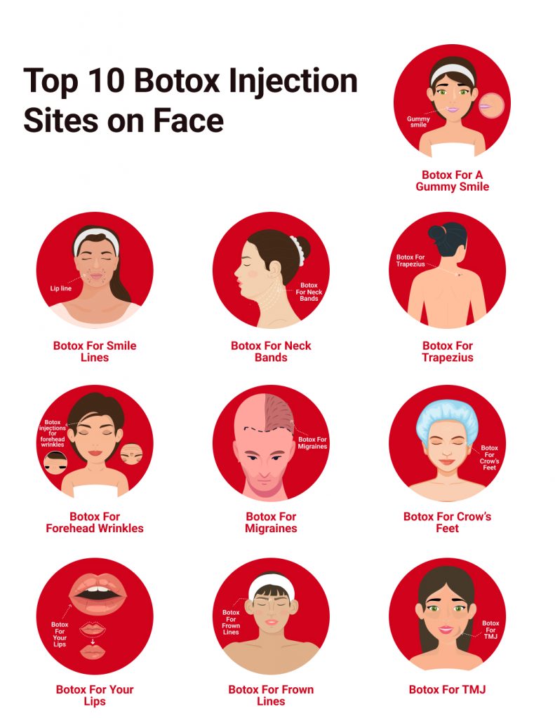 Botox Injection Sites