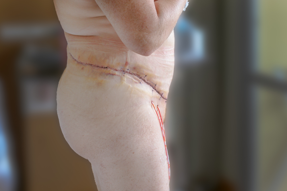 Seroma After Tummy Tuck