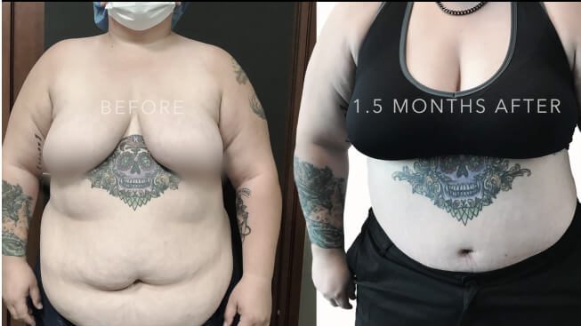 Tummy Tuck Recovery Timeline