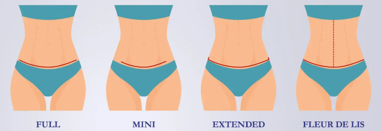 Types of Tummy Tuck