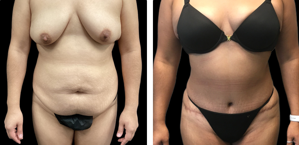 Tummy Tuck Before and After Result