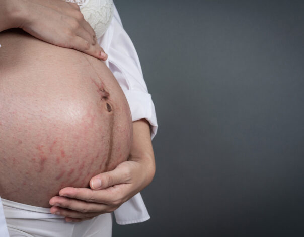 how to prevent stretch marks during pregnancy