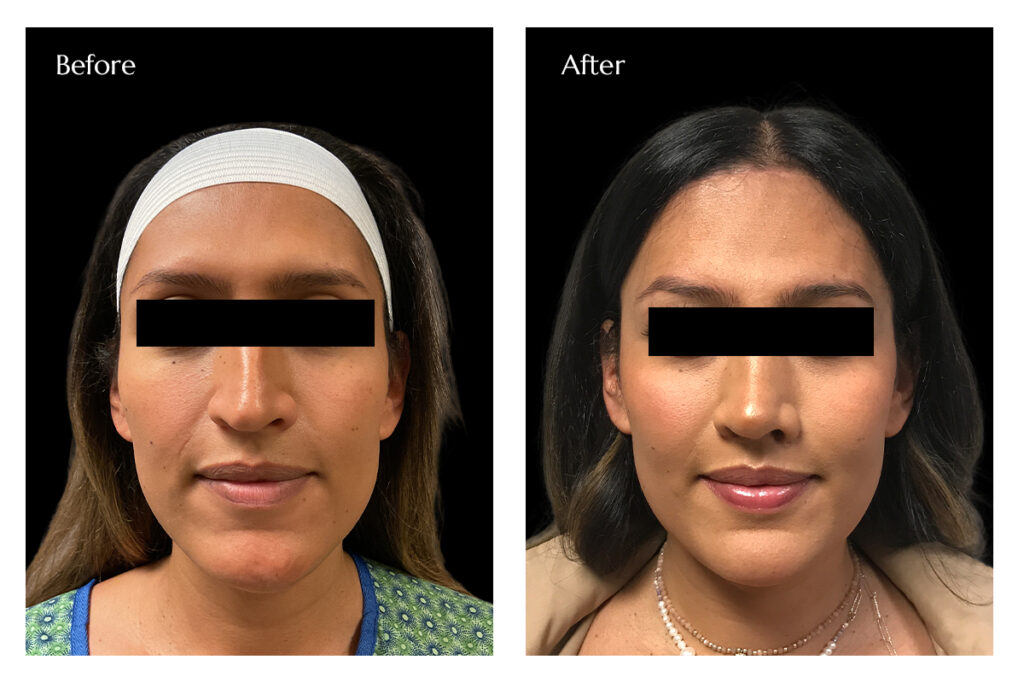 FFS with Breast Augmentation Before and After Images