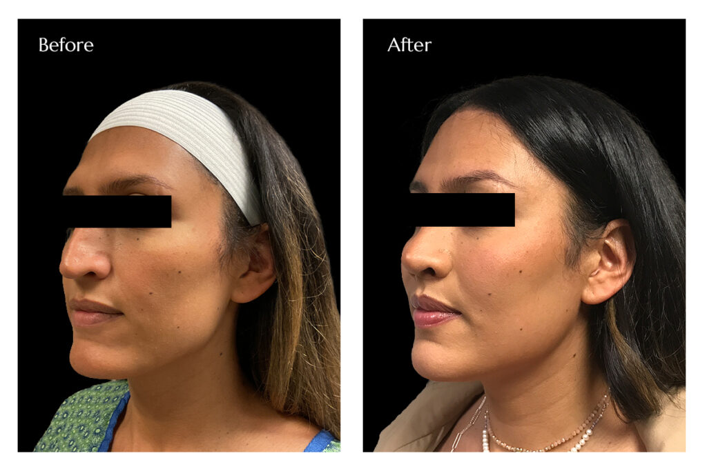 FFS with Breast Augmentation Before and After