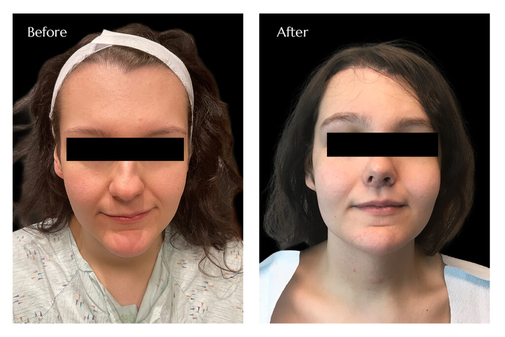 FFS with Breast Augmentation Before and After