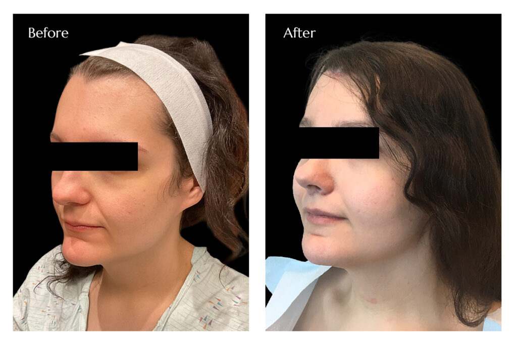FFS with Breast Augmentation Before and After Images