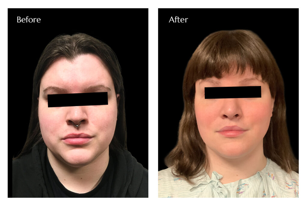 FFS with Hairline reduction Before and After