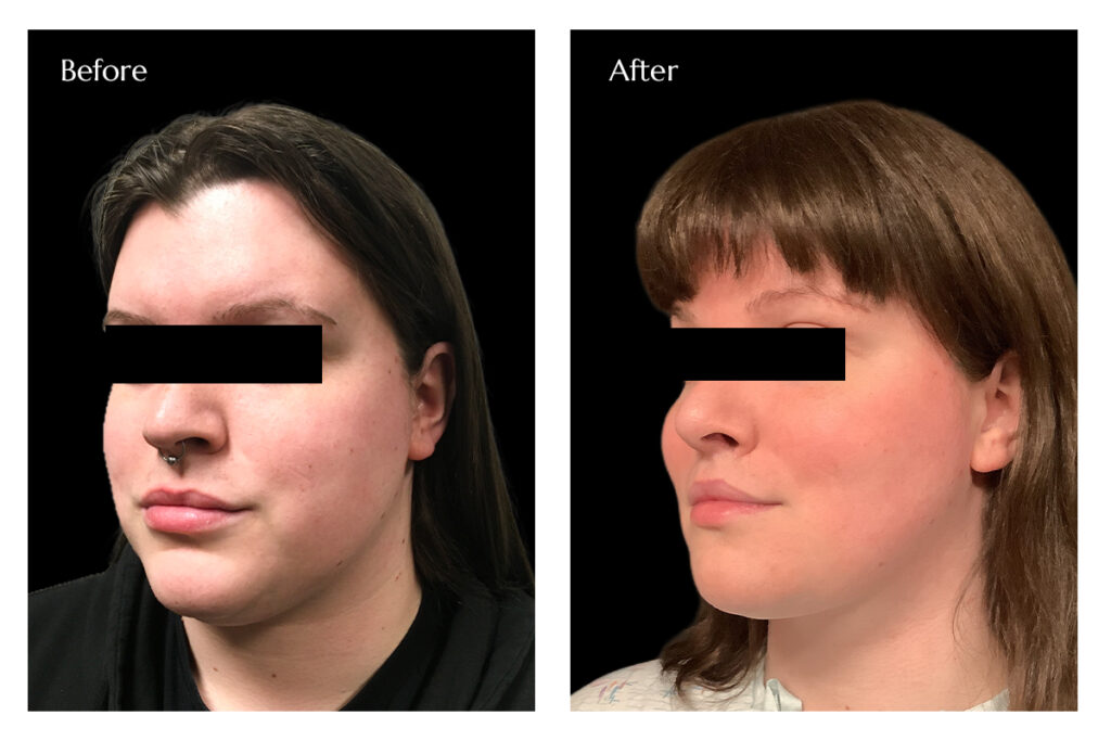 FFS with Hairline reduction Before and After Images