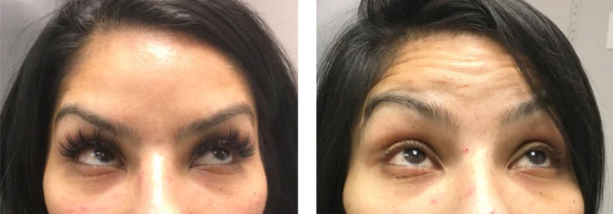 botox before and after image