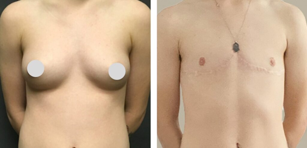 FTM Top Surgery before and after photos